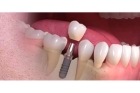 Недорогая имплантация зубов