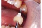 Имплантация зубов в стоматологии