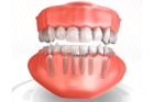 Имплантация зубов с установкой