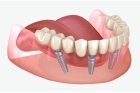 Услуги имплантации зубов