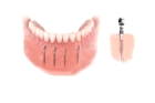 Имплантация зубов всей челюсти