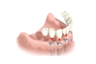 Имплантация при отсутствии зубов