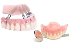 Импланты в стоматологии