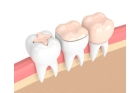 Установка зубных коронок на передние зубы