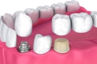Установка зубных коронок на жевательные зубы