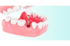 Зубной имплант нижнего зуба