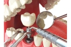 Установка имплантов в стоматологии
