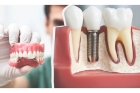 Установка корейского импланта зуба