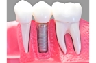 Установка импланта 1 зуба