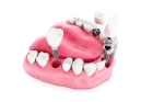 Установка коронки на имплант зуба