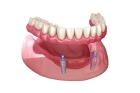 Установка зубных коронок в стоматологии