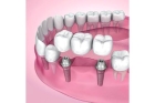 Установка зубных коронок на задние зубы