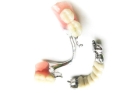Бюгельные нижние зубные протезы