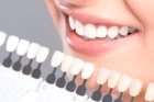 Коронки на зубы в стоматологии