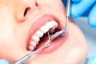 Лечение глубокого кариеса зубов