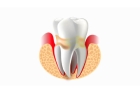 Лечение острого периодонтита зуба
