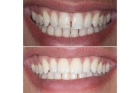 Реставрация зубов в стоматологии