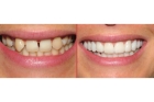 Реставрация нижних зубов