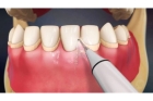 Снятие зубных отложений ультразвуком