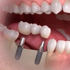Протезирование зубов в рассрочку