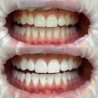 Отбеливание зубов 