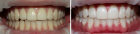 Отбеливание эмали зубов