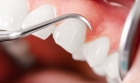 Снятие над и поддесневых отложений с зубов 