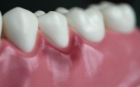 Лечение десен зубов 