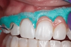 Покрытие зубов фторсодержащими лаками 