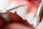 Лечение пародонтоза зубов 