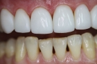 Восстановление ряда зубов 