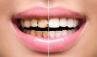 Восстановление кариозного зуба
