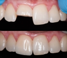 Восстановление зуба (Титановый пост)  