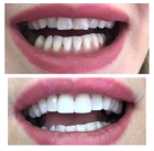 Восстановление зуба под коронку  