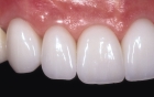 Косметическое восстановление зуба виниром 