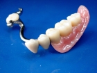 Бюгельное протезирование зубов 