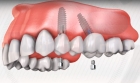 Протезирование зубов на импланте  