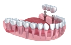 Несъемное протезирование зубов на импланте    