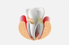 Лечение периодонтита одноканального зуба