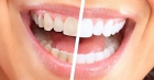 Восстановление эмали зуба
