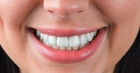 Эстетическое восстановление формы зуба