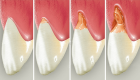 Восстановление дефектов зуба