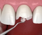 Восстановление формы зуба