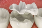 Восстановление зуба керамической вкладкой