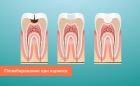Пломбирование двухканального зуба