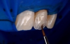 Художественная реставрация зуба с использованием микроскопа