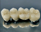Металлокерамическая коронка зуба