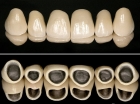 Металлокерамическая зубная коронка
