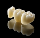 Керамическая коронка на зуб