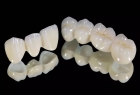 Коронка зуба из оксида циркония